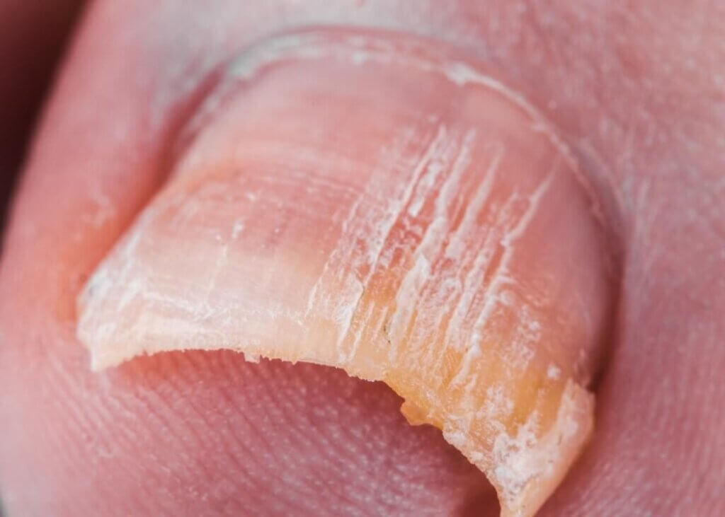 汚い爪の変色やにごり・ガサつきに。足の爪水虫専用薬用ジェル