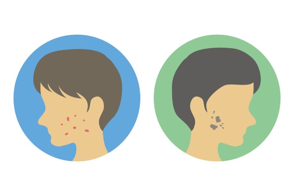 男の4大肌悩みに。3つの有効成分配合の薬用ヘパリン類似物質クリーム