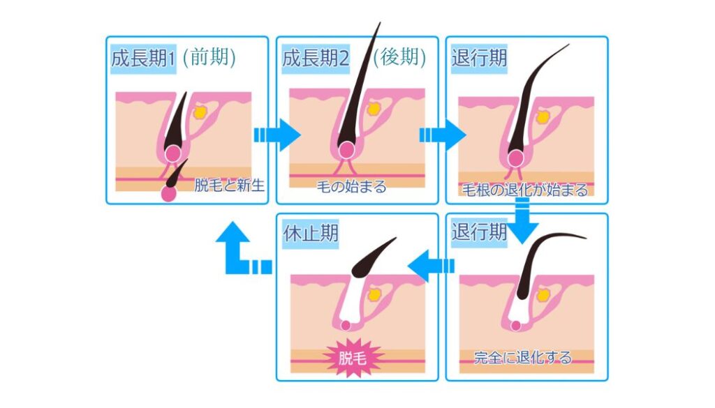 ヒゲ脱毛開始19ヶ月。実験的に3ヶ月間治療を中断して得た気づき