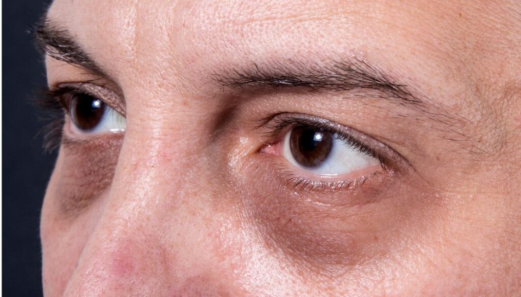 目の下の様々なトラブルは見た目を損い老けて見える1つの原因