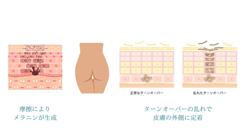 男性も汚尻はNG。黒ずみや肌トラブルのおすすめケアアイテム4選