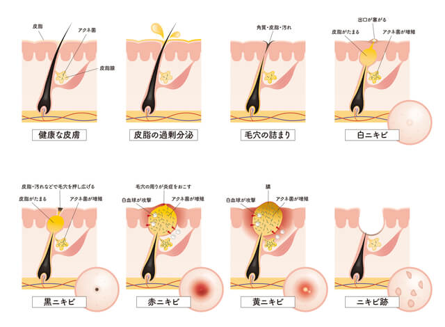 男の鼻の黒ずみ・ニキビに。2大有効成分配合いちご鼻洗顔クレイパック
